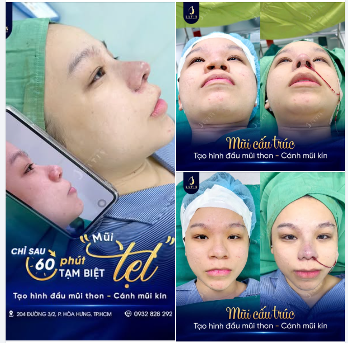 MỘT CHIẾC MŨI ĐẸP HƠN – MỘT DIỆN MẠO TỰ TIN HƠN