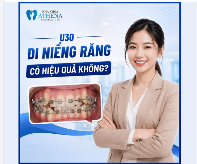 U30, NIỀNG RĂNG CÓ HIỆU QUẢ KHÔNG?