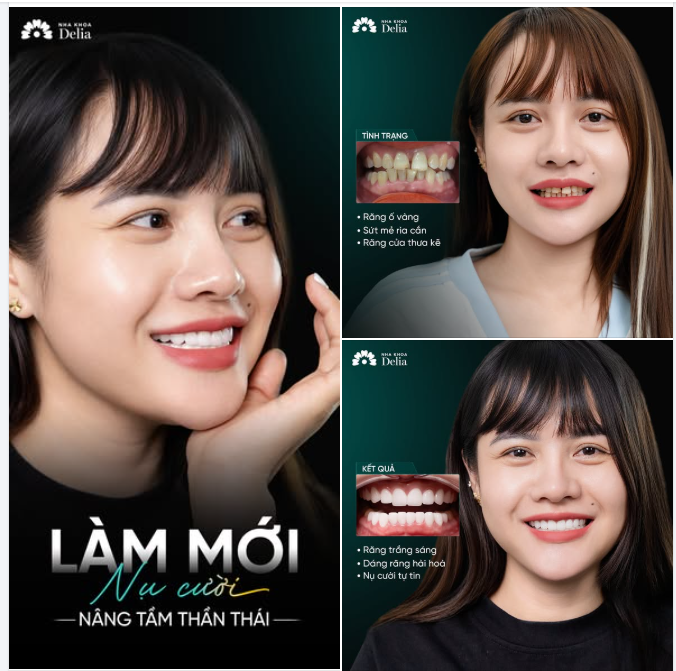 "TỪ HẢI PHÒNG VỀ HÀ NỘI LÀM ĐƯỢC BỘ RĂNG SỨ NÀY QUÁ XỨNG ĐÁNG!"
