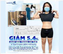 GIẢM MỠ BỤNG AN TOÀN - CÔNG NGHỆ LIPO ULTRASOUND