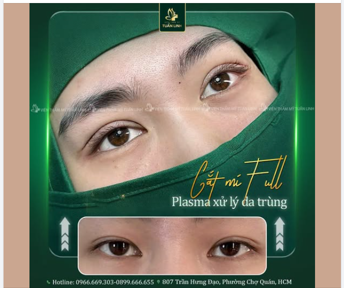 CẮT MÍ PLASMA – ĐÔI MẮT TO TRÒN, TRẺ TRUNG TỰ NHIÊN!!