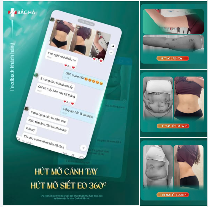 COMBO SIẾT EO 360 + HÚT MỠ CÁNH TAY – THAY ĐỔI RÕ TỪNG ĐƯỜNG NÉT