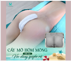 Hõm mông hóp khiến đường cong cơ thể thiếu sự cân đối, làm vóc dáng chưa đạt được sự mềm mại cuốn hút như mong muốn.