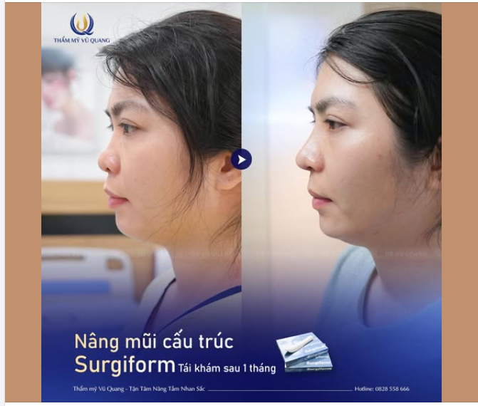 Mong rằng những hình ảnh sắc nét từ bạn gái sau khi nâng mũi tại Thẩm mỹ Vũ Quang sẽ giúp bạn có thêm động lực làm mới bản thân ngay hôm nay.