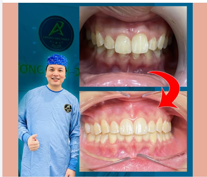 Niềng Răng Bằng Invisalign So Với Niềng Răng Truyền Thống