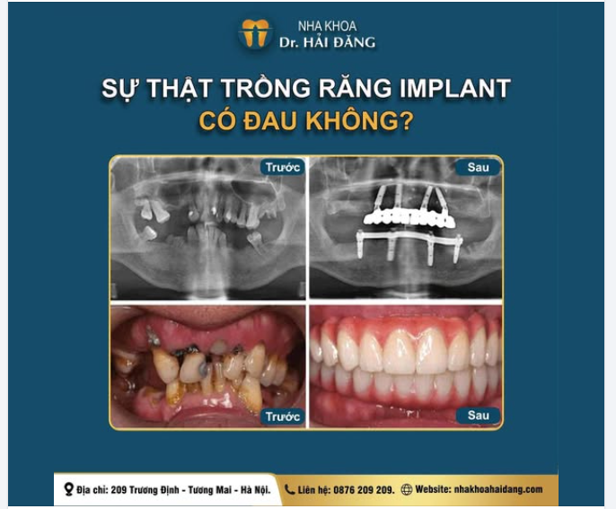 TRỒNG RĂNG IMPLANT CÓ ĐAU KHÔNG?