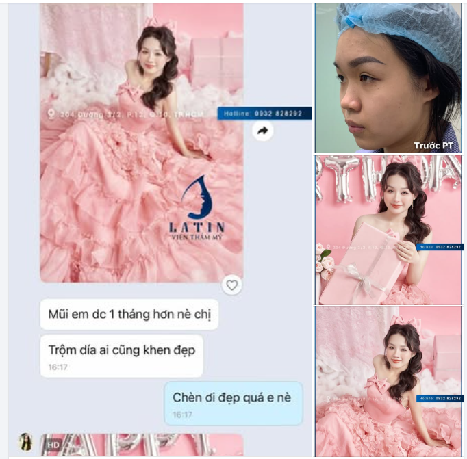 “Mũi em được hơn 1 tháng nè chị, trộm vía ai cũng khen đẹp!”
