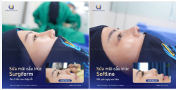 SỬA MŨI CẤU TRÚC SURGIFORM - ĐẸP TỰ NHIÊN, CHUẨN NHÂN TRẮC HỌC
