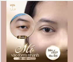 Không có mí  Da trùng, thừa nhiều  Đuôi mắt cụp