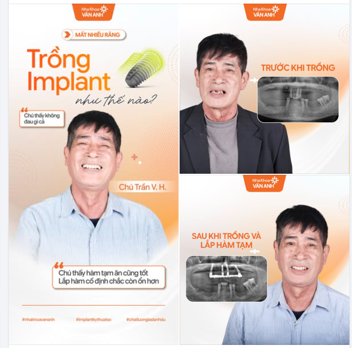 CẮM NHIỀU IMPLANT MÀ KHÔNG ĐAU, LẠI CÒN ĂN ĐƯỢC NGAY? CÓ THẬT KHÔNG?