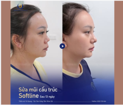 GIẢI CỨU CHIẾC MŨI CO RÚT - TÁI TẠO DIỆN MẠO SAU 13 NGÀY