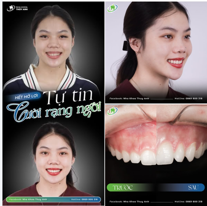 HẾT HỞ LỢI - TỰ TIN CƯỜI RẠNG NGỜI