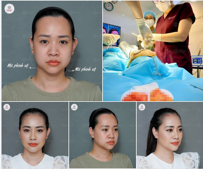 THỦ THUẬT LẤY TÚI MỠ MÁ TRONG CÓ PHỨC TẠP KHÔNG?
