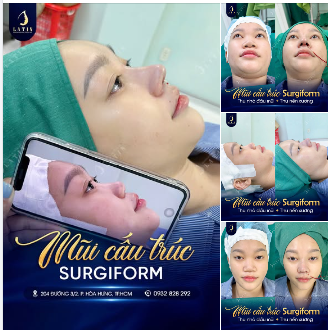 CHẤT LIỆU ĐỨNG SAU NHỮNG DÁNG MŨI TRIỆU VIEW