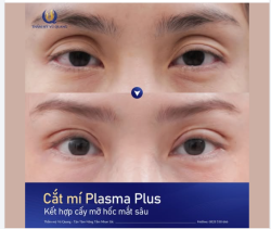 TÁI SINH ĐÔI MẮT TRẺ LẠI 10 TUỔI VỚI COMBO CẮT MÍ