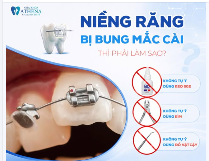 NIỀNG RĂNG BỊ BUNG MẮC CÀI: ĐỪNG HOẢNG HỢP, HÃY LÀM NGAY 3 ĐIỀU NÀY!