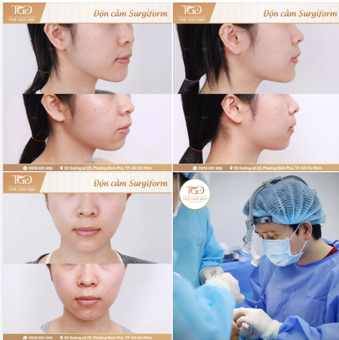 Từ Góc Nghiêng “Nhạt” Đến Góc Nghiêng Cuốn Hút Sau Độn Cằm Surgiform