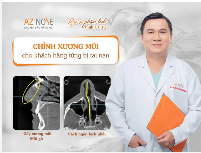 Mũi gồ, lệch hay biến dạng sau chấn thương không chỉ là vấn đề ở bề mặt.