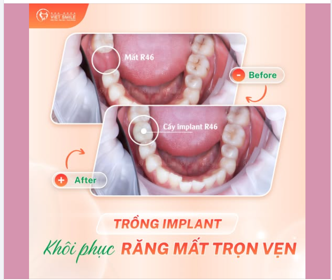 HOÀN THIỆN RĂNG SỐ 6 BẰNG IMPLANT – ĐẢM BẢO THẨM MỸ, PHỤC HỒI ĂN NHAI
