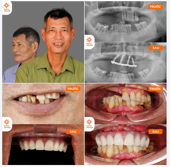 ĐẶT LỢI ÍCH LÂU DÀI CỦA KHÁCH HÀNG LÊN HÀNG ĐẦU: KHI CHUYÊN MÔN KHÔNG CHỈ DỪNG LẠI Ở VIỆC TRỒNG RĂNG