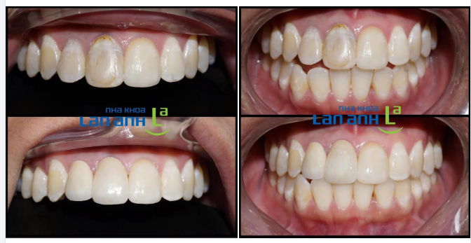 Chỉ 2 răng sứ – thay đổi cả nụ cười