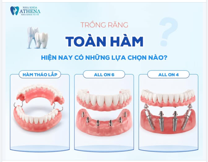 TRỒNG RĂNG TOÀN HÀM HIỆN NAY CÓ NHỮNG LỰA CHỌN NÀO?