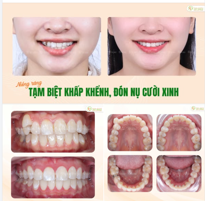 NIỀNG MẮC CÀI – TẠM BIỆT RĂNG KHỂNH, ĐÓN NỤ CƯỜI CÂN ĐỐI
