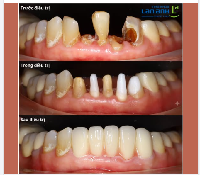 Chân răng còn - Cơ hội giữ lại răng thật vẫn còn!