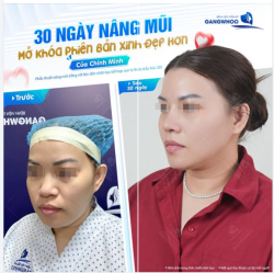 30 NGÀY NÂNG MŨI MỞ HÓA XINH ĐẸP CỦA CHÍNH MÌNH