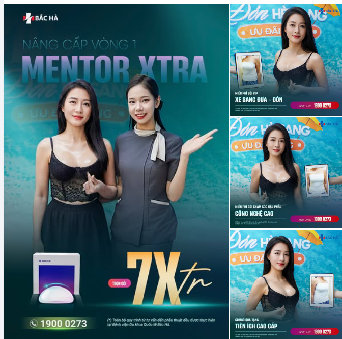 Feedback thực tế sau nâng ngực với dòng túi Mentor Xtra: form V1 đầy đặn, cân đối, rõ dáng nhưng vẫn giữ được sự mềm mại tự nhiên.