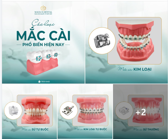 NIỀNG RĂNG NÊN CHỌN LOẠI MẮC CÀI NÀO?  ĐÂY LÀ CÁC LOẠI MẮC CÀI PHỔ BIẾN NHẤT HIỆN NAY!