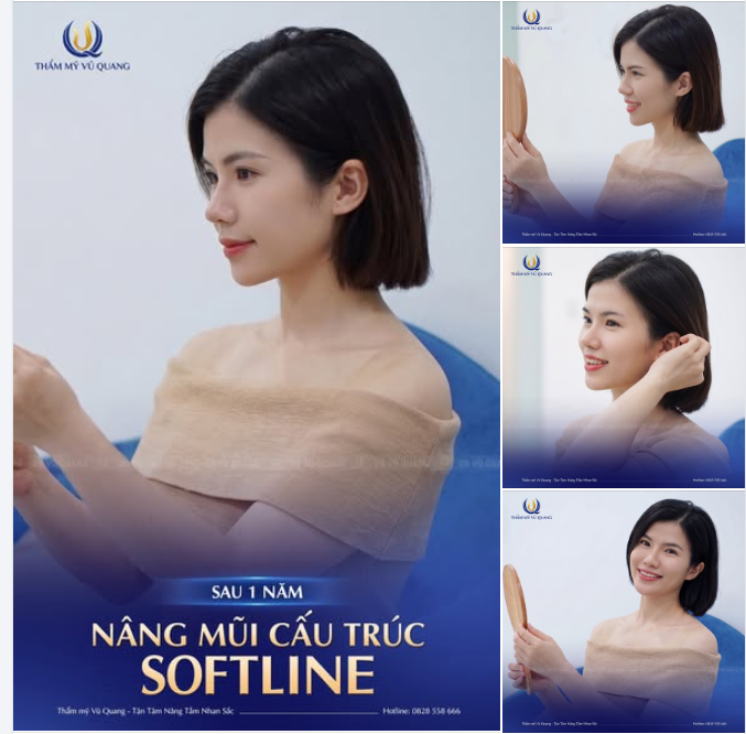 Tròn 1 năm ngày vị khách hàng thân yêu lựa chọn nâng mũi cấu trúc Softline tại Thẩm mỹ Vũ Quang.