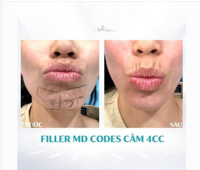 VÙNG CẰM NHĂN NHÚM MỖI KHI BẠN CỬ ĐỘNG NÓI CƯỜI, CHU MÔI - CẢI THIỆN NHƯ THẾ NÀO?