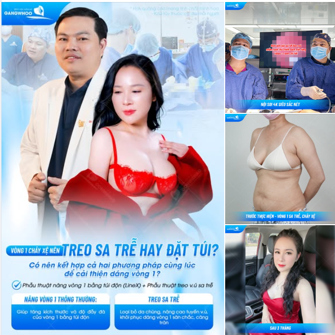 VÒNG 1 CHẢY XỆ NÊN TREO SA TRỄ HAY ĐẶT TÚI? CÓ NÊN KẾT HỢP CẢ HAI PHƯƠNG PHÁP CÙNG LÚC ĐỂ CẢI THIỆN DÁNG VÒNG 1?