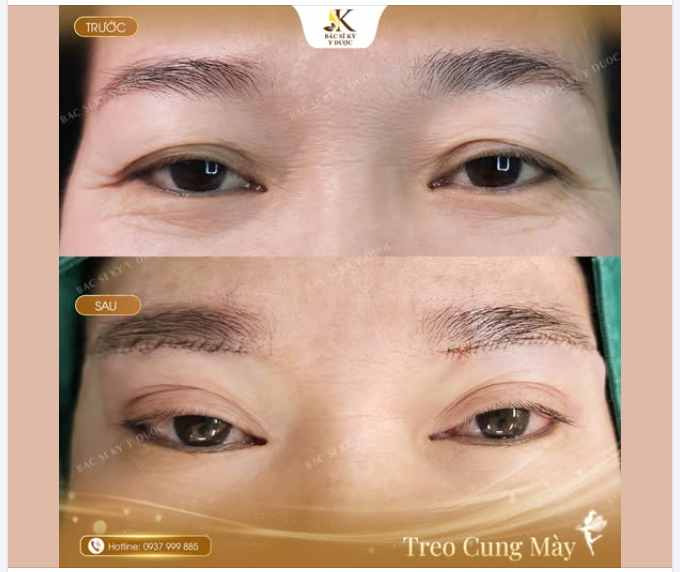 Đôi mắt trẻ hơn – Tầm nhìn cũng thoải mái hơn