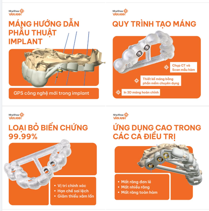 LOẠI BỎ TỚI 99% SAI SỐ KHI TRỒNG IMPLANT NHỜ CÔNG NGHỆ MÁNG ĐỊNH VỊ HISAFE