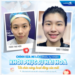 KHÔI PHỤC SỰ HÀI HÒA VÀ CHỨC NĂNG HOẠT ĐỘNG CỦA MẮT