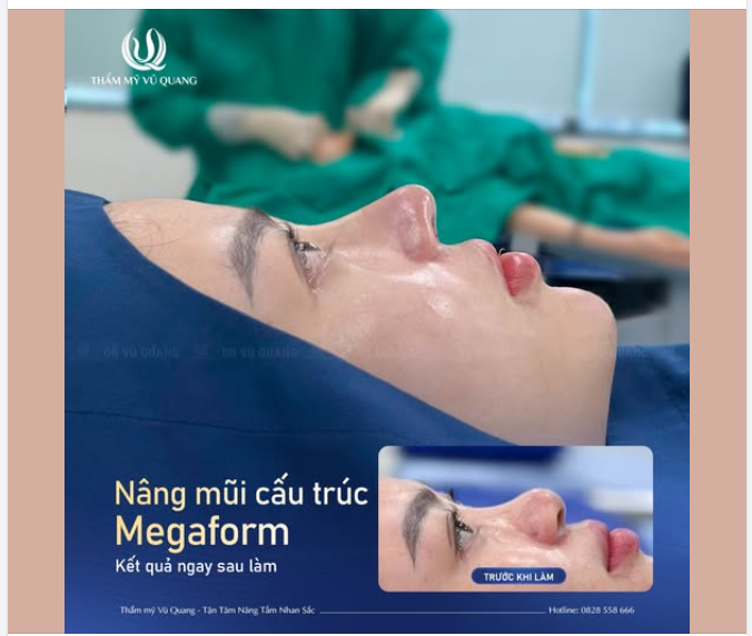 HÀNH TRÌNH 600KM ĐI TÌM DÁNG MŨI HOÀN HẢO
