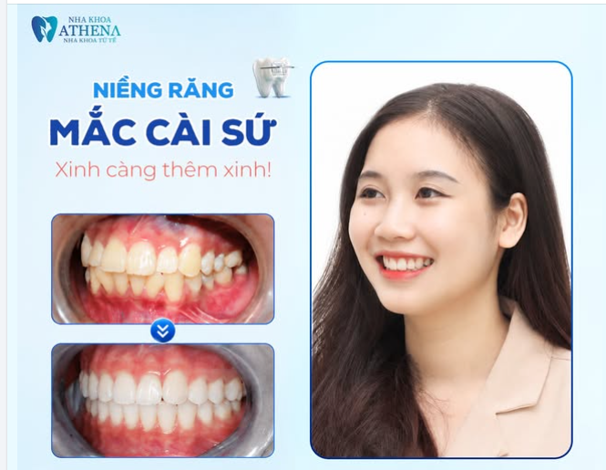 NIỀNG MẮC CÀI SỨ - XINH CÀNG THÊM XINH