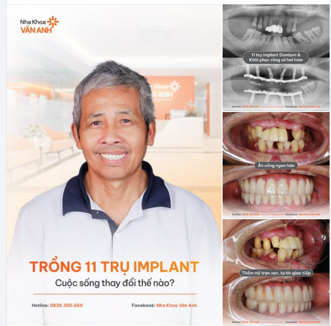 11 TRỤ IMPLANT - ĐỔI LẠI CHẤT LƯỢNG CUỘC SỐNG CỦA U70