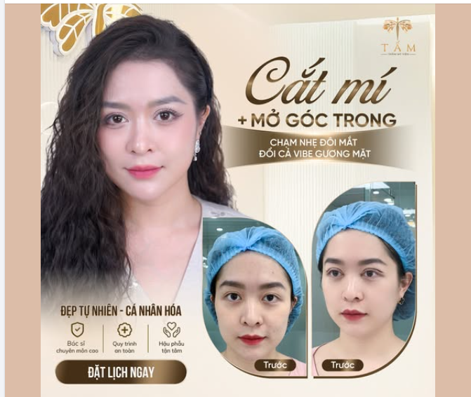 Khách hàng lựa chọn cắt mí kết hợp mở góc mắt trong để cải thiện tình trạng mắt ngắn, thiếu điểm nhấn và ánh nhìn còn hơi mệt mỏi.