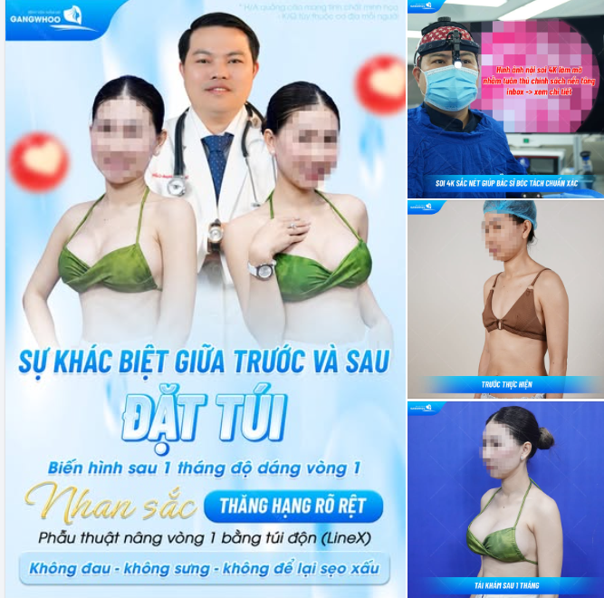 SỰ KHÁC BIỆT GIỮA TRƯỚC VÀ SAU ĐẶT TÚI - BIẾN HÌNH SAU 1 THÁNG ĐỘ DÁNG VÒNG 1, NHAN SẮC THĂNG HẠNG RÕ RỆT