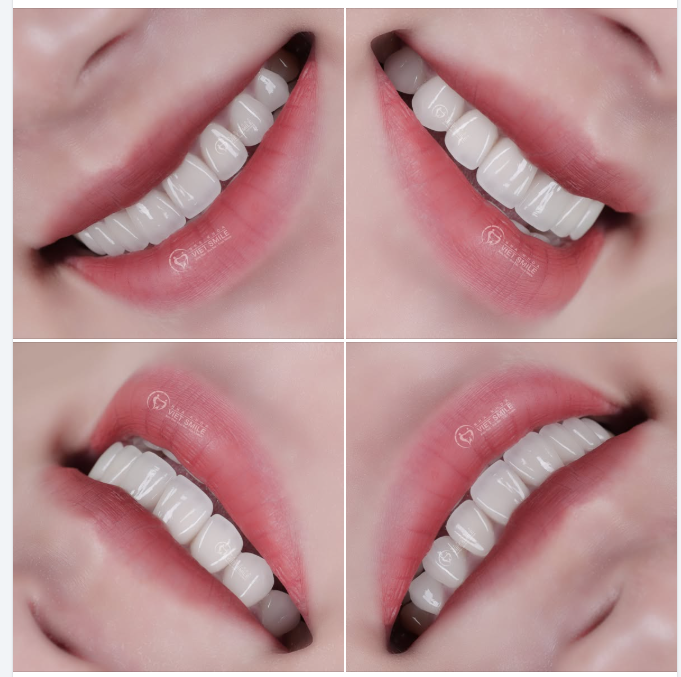NGẠI GIAO TIẾP VÌ HÀM RĂNG NHIỄM TETRACYCLINE VÀ KẾT QUẢ NGOÀI MONG ĐỢI KHI ĐẾN VIET SMILE