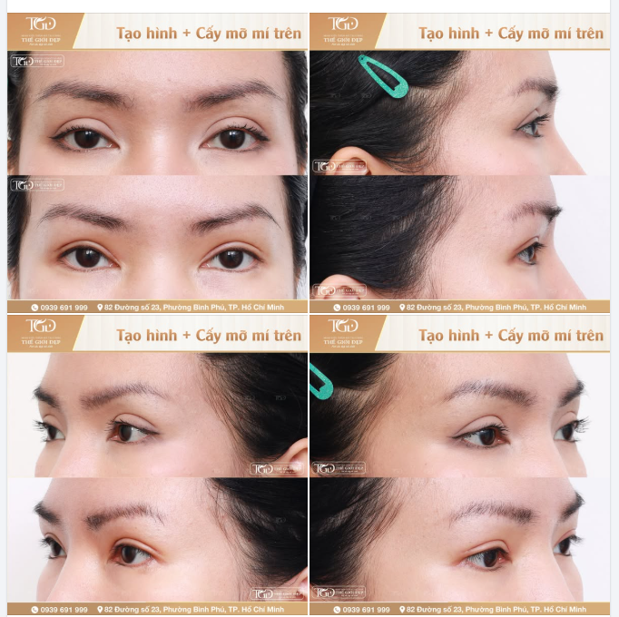 Tái phẫu thuật mí mắt kết hợp cấy mỡ hốc mắt  Giải pháp cải thiện đôi mắt hài hòa, tươi trẻ và có sức sống hơn.