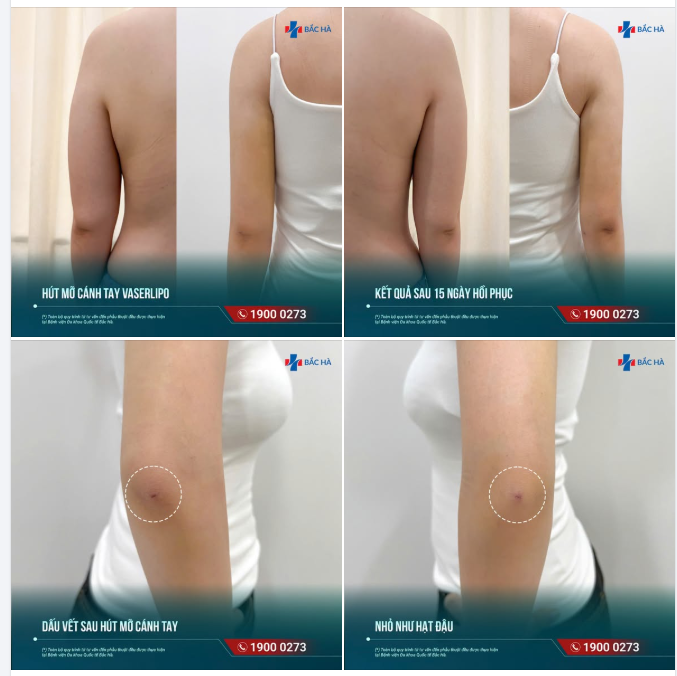 15 NGÀY SAU HÚT MỠ CÁNH TAY – KHÁC BIỆT NHÌN THẤY RÕ!