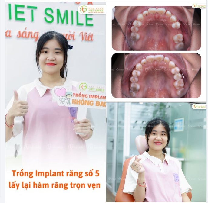 CẤY IMPLANT – CHẤM DỨT NỖI LO MẤT RĂNG!