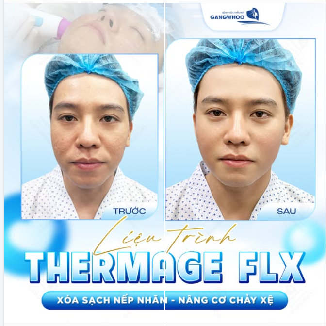 TRẺ HÓA THERMAGE FLX  Xóa sạch nếp nhăn - Nâng cơ chảy xệ