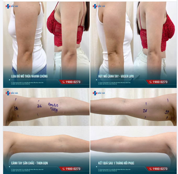 HÚT MỠ CÁNH TAY GIẢM ĐẾN 40% – TẶNG KÈM HÚT MỠ NÁCH