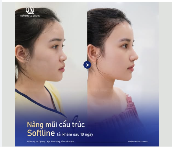 SỞ HỮU VISUAL "PHÁT SÁNG" SAU 10 NGÀY NÂNG MŨI