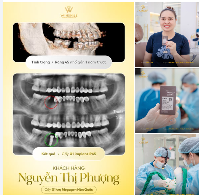 CẤY IMPLANT ĐƠN GIẢN HƠN BẠN NGHĨ KHI ĐIỀU TRỊ MẤT RĂNG ĐÚNG THỜI ĐIỂM